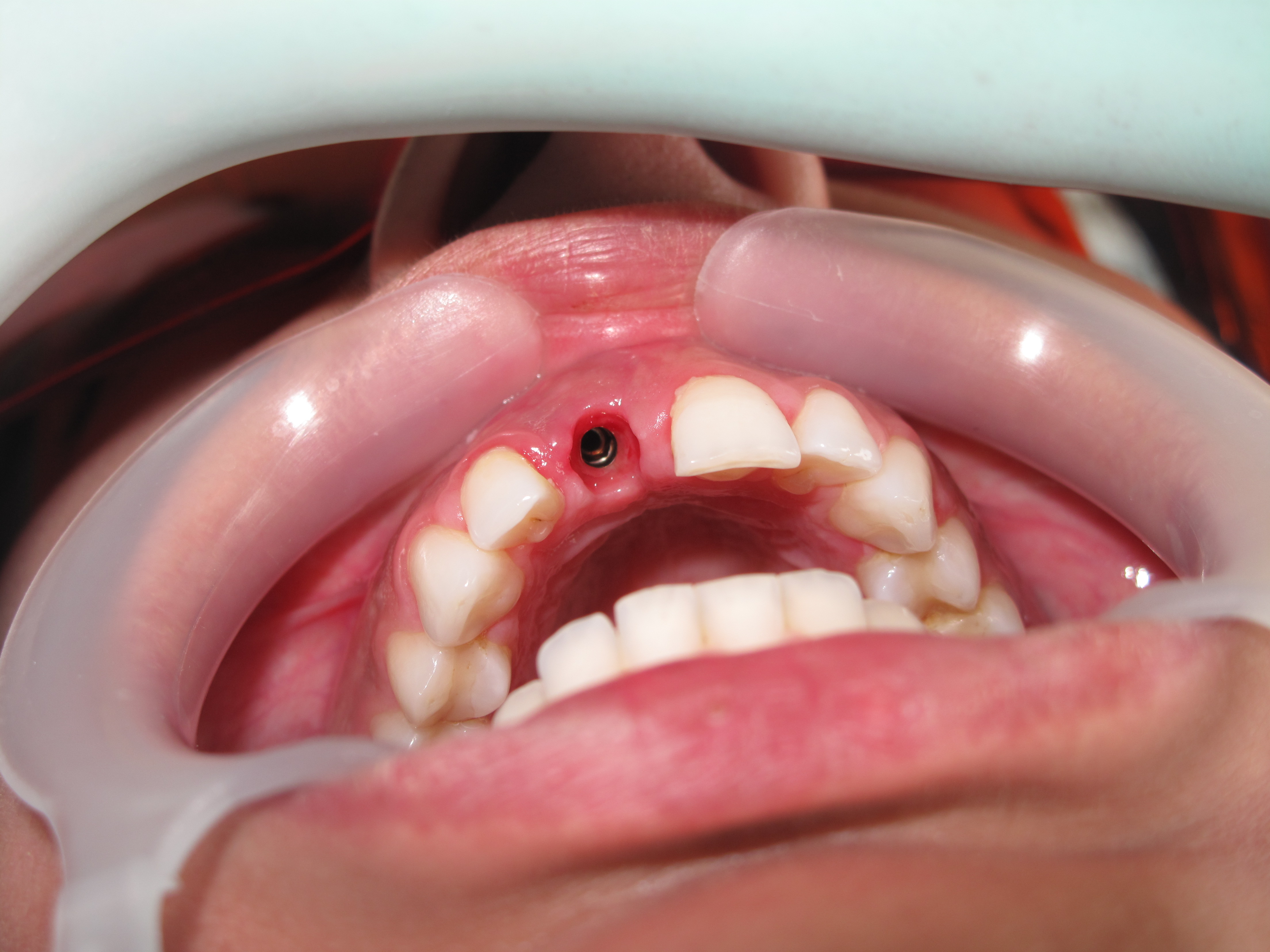 Oral Surgery Pictures 40